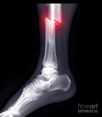 Full leaked Brokenleg private onlyfans photo